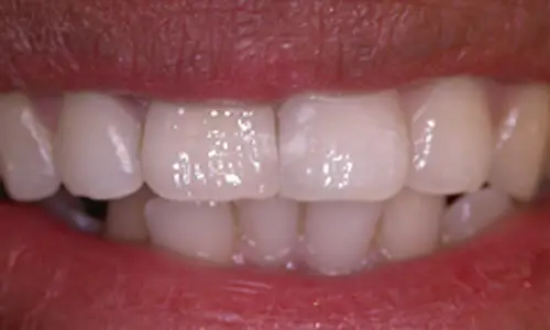 After Dental Implants treatment at Hometown Dental showing beautiful smile transformation results