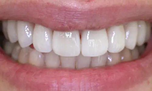 After Porcelain Veneers treatment at Hometown Dental showing beautiful smile transformation results