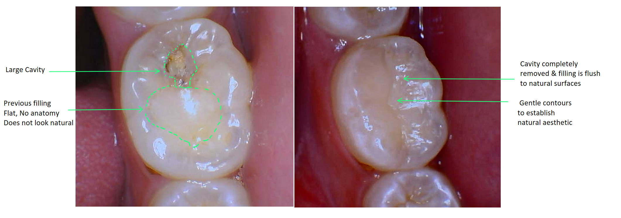 Cavity Filling before and after