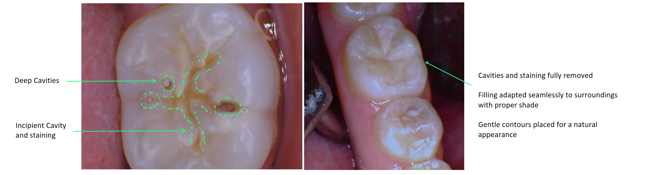 Cavity Filling before and after