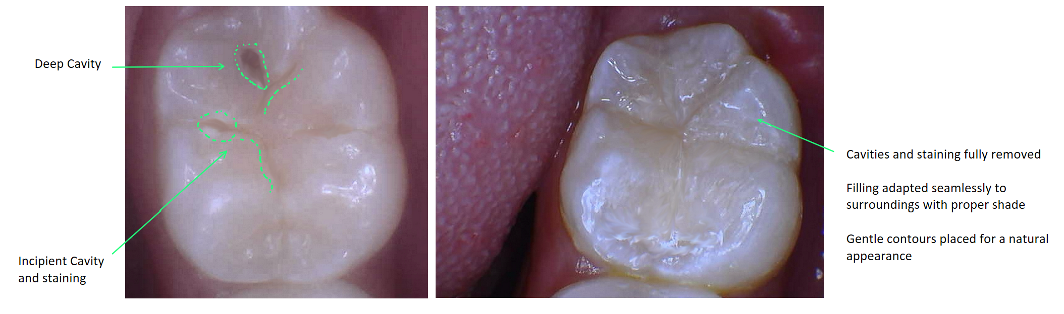 Cavity Filling before and after