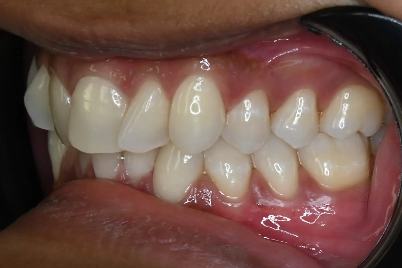 Before Clear Aligners treatment at Hometown Dental showing patient's initial dental condition