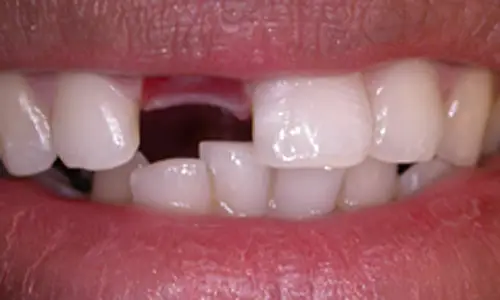 Before Dental Implants treatment at Hometown Dental showing patient's initial dental condition