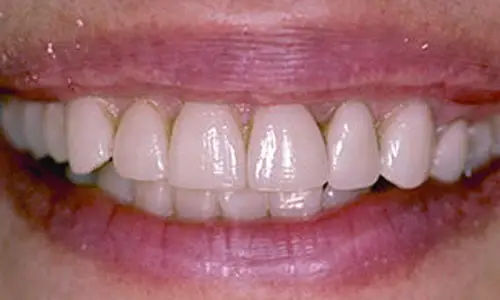 Before Teeth Whitening treatment at Hometown Dental showing patient's initial dental condition
