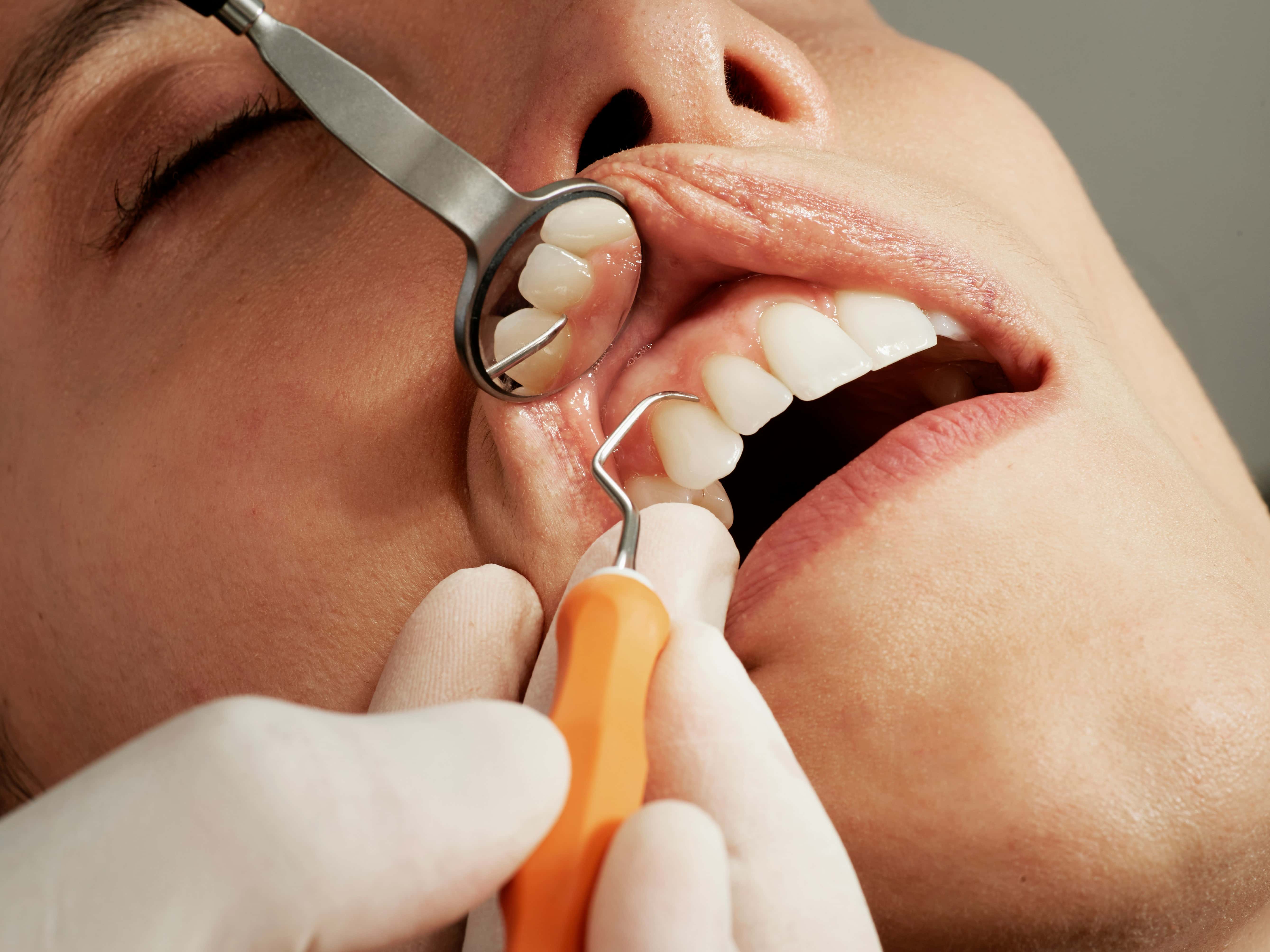 Broken Tooth Repair at Hometown Dental