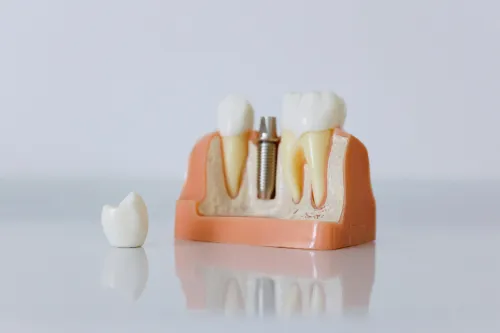 Dental Implants at Hometown Dental