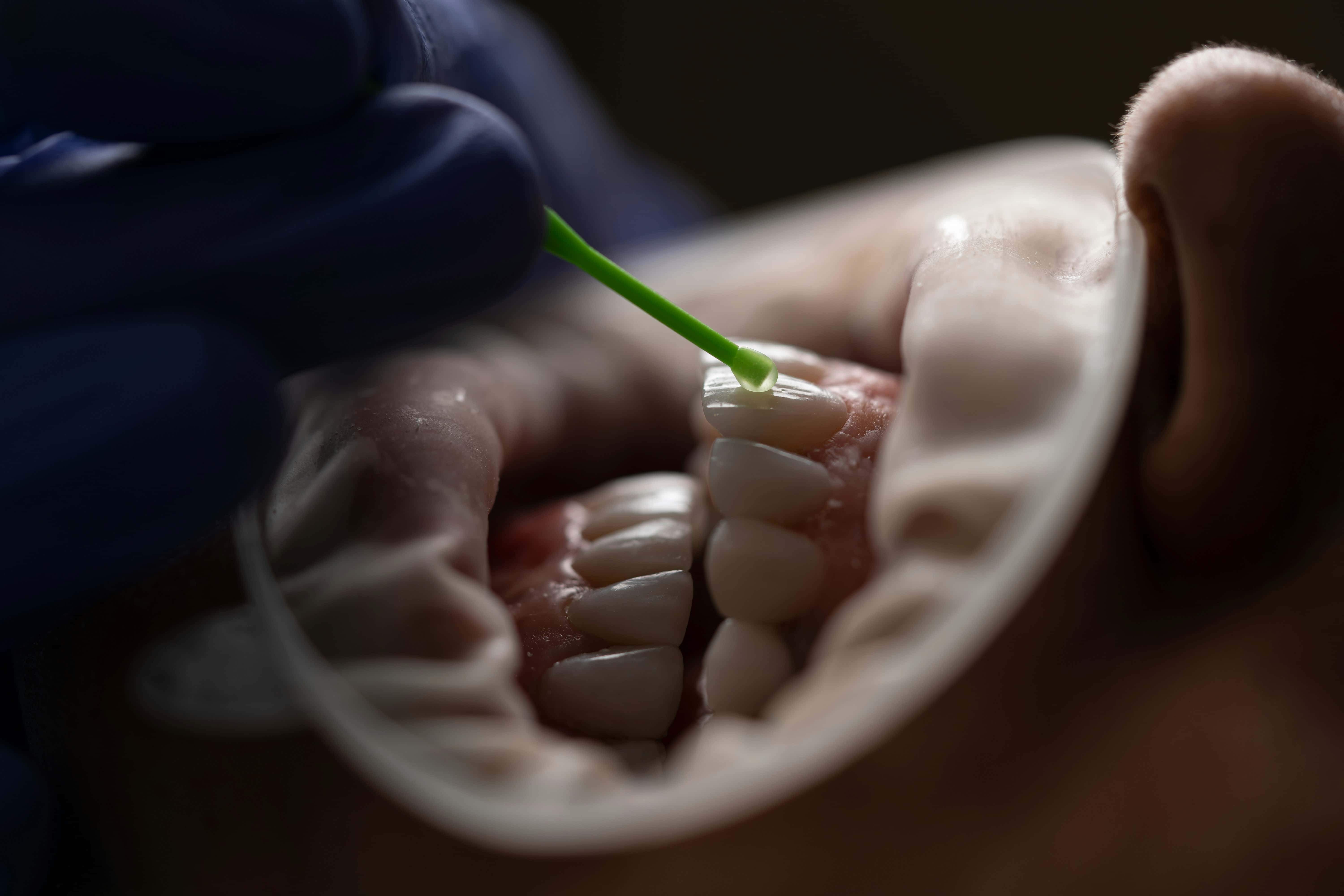 Inlays & Onlays at Hometown Dental
