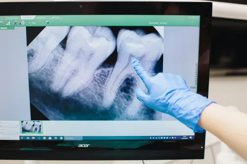 Oral Cancer Screening at Hometown Dental